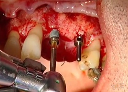 CLINICAL VIDEO Vertical Augmentation,...