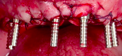 Fixed Full Arch Rehabilitations - From Grafting to Graftless