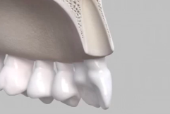 Implant placement in fresh extraction sockets| Prof Mariano Sanz