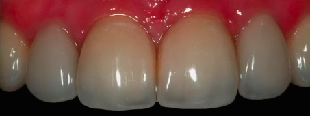 Interdisciplinary Management of Implants in the Aesthetic Zone  | Dr Tidu Mankoo