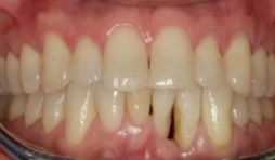 CLINICAL VIDEO Extraction Site and Vertical Ridge Augementation in the Lower Ant