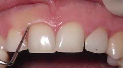 CLINICAL VIDEO Periodontal Crown Lengthening of 10 Maxillary Front Teeth