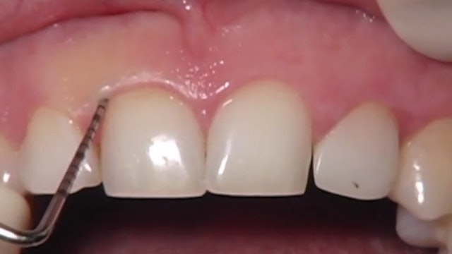 CLINICAL VIDEO Periodontal Crown Lengthening of 10 Maxillary Front Teeth