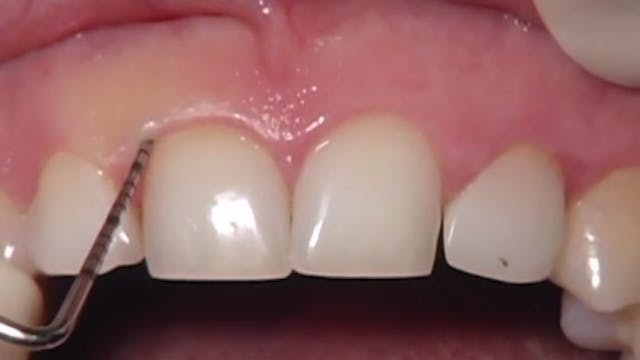 CLINICAL VIDEO Periodontal Crown Leng...
