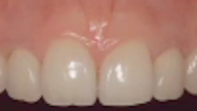 Minimally Invasive Implant Surgery: R...