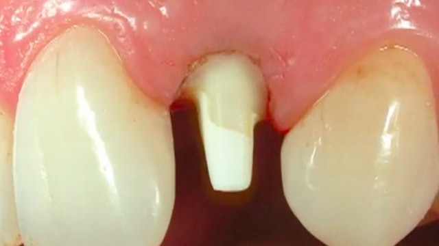 CLINICAL VIDEO Post and Core Restoration: Replacement of missing tooth structur