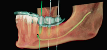 Predictable and Esthetic Implant Results with Guided Surgery