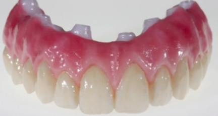 Complete Zirconia Restorations - Implant Supported