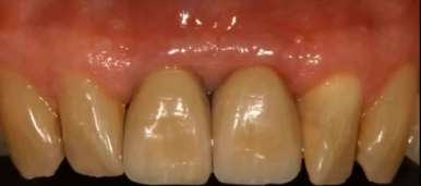 Clinical Elements In Achieving Natural Implant Aesthetics (JAPANESE LANGUAGE ON