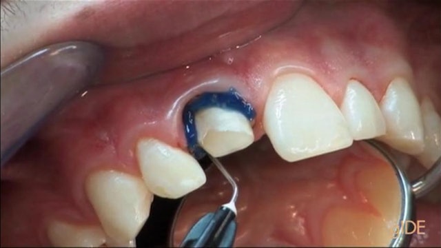 CLINICAL VIDEO New Single-Resin Treatment Modality For a Direct Post and Core Bu