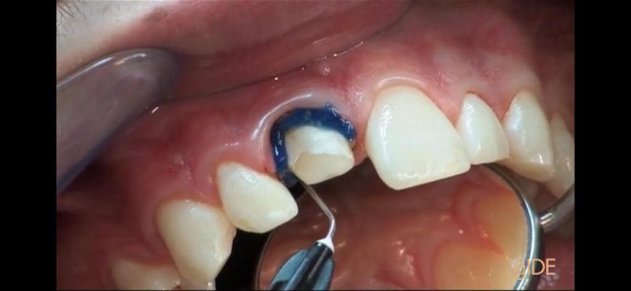 CLINICAL VIDEO New SingleResin Treatment Modality For a Direct Post