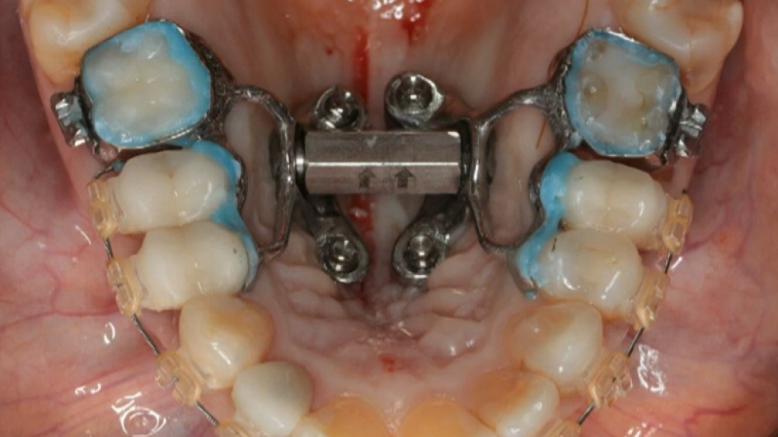 The Complete Digital Workflow - Part 2: Temporary Anchorage Devices (TAD)