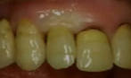 Soft Tissue Stability Around Implants in the Esthetic Zone; Can it Always be Pr
