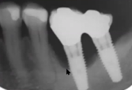 LIVE OFFICE HOUR and Q&A | Maintaining Dental Implants | Ms Karima Bapoo-Mohamed