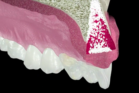 Benefits of Extraction Socket Management | Dr France Lambert