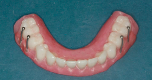 Immediate Loading - Part 1: The All-on-4 and More