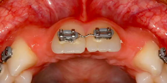 A-Z in Restorative Implant Dentistry (Part 6a) - Maximizing Aesthetic Potential