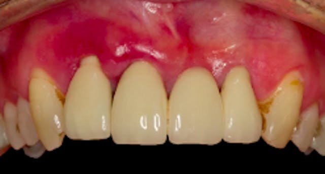 Surgical Management of the Failed Imp...