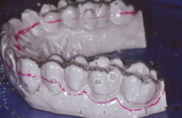 A-Z in Restorative Implant Dentistry (Part 3b) - Surgical Guides: A Basic Look
