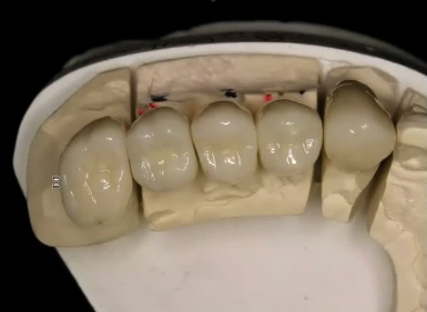 Treatment Planning and Prosthetic Procedures for Single Implant Crowns