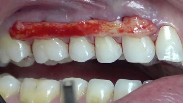 CLINICAL VIDEO The Periodontal Tunnel...