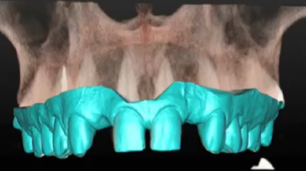 Delivery of Immediate Final Restorations at the Time of Implant Surgery - A Com