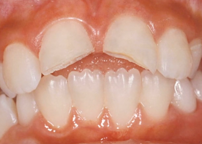 The Class IV restoration: Maximizing esthetics and predictability