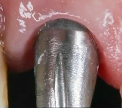 CLINICAL VIDEO Treatment of missing maxillary premolar with an One-Piece Dental 