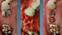 Immediate Tooth Replacement and Restorative challenges