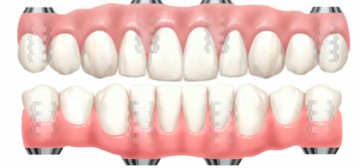 The All on 4 Concept: Diagnosis to Delivery Part 3 - Clinical Patient Presentat