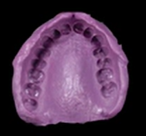 Optimal Prosthetic Planning – Esthetic & Function | Dr Francesco Mintrone