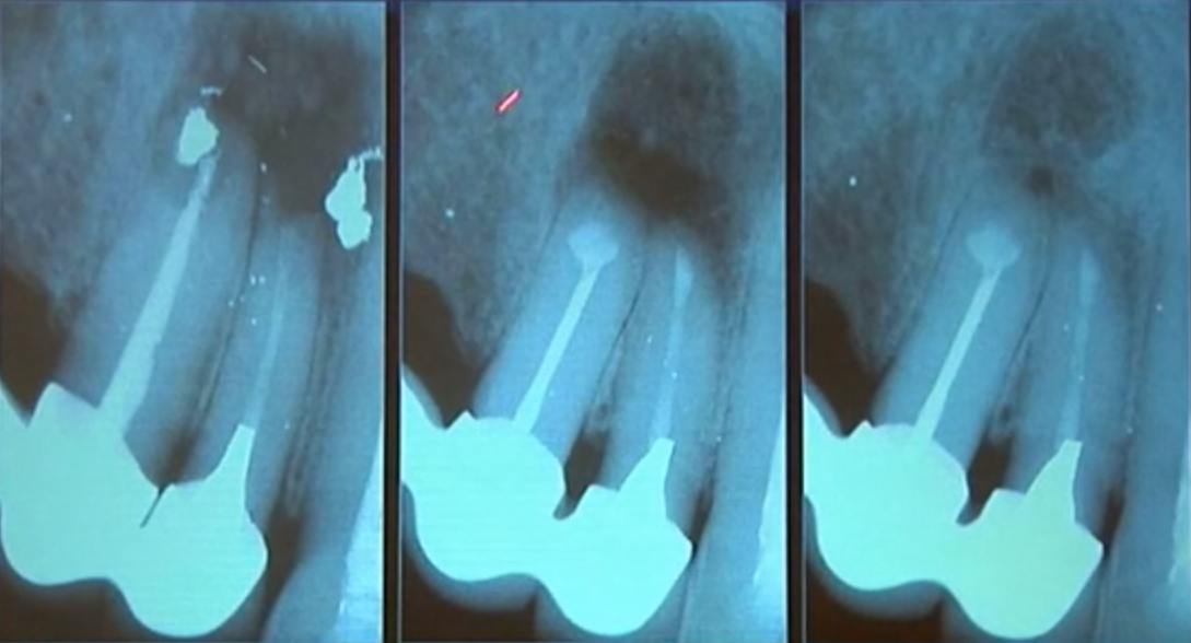 The Success of Endodontic Therapy - Healing and Function