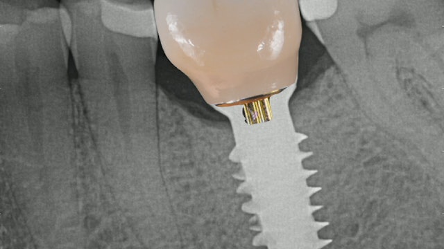 Replacing a Mandibular First Molar Using a Tissue Level Implant
