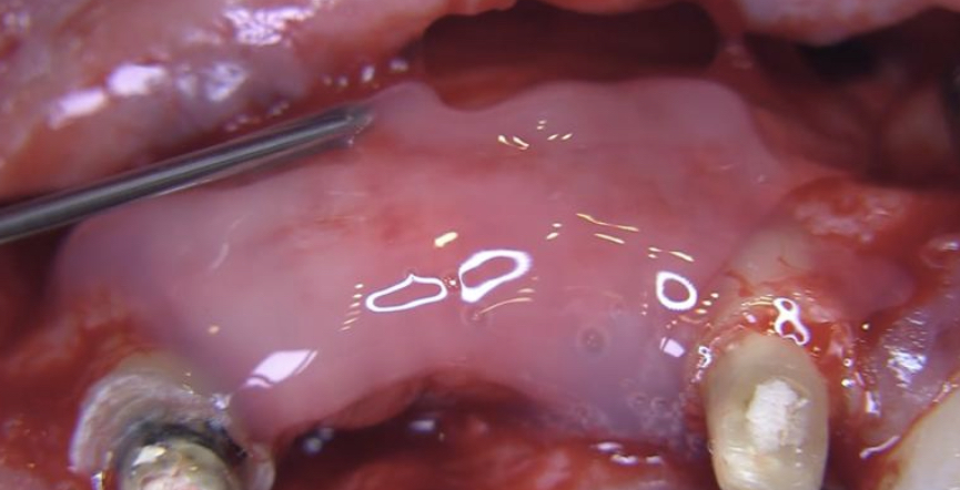 CLINICAL VIDEO Emdogain application in conjunction with Implant placement and si