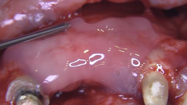 CLINICAL VIDEO Emdogain application in conjunction with Implant placement and si