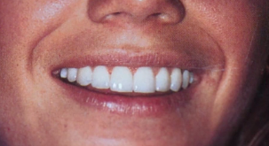 Artistic Principles applied to esthetic Dentistry. Micro vs. Macro esthetics de