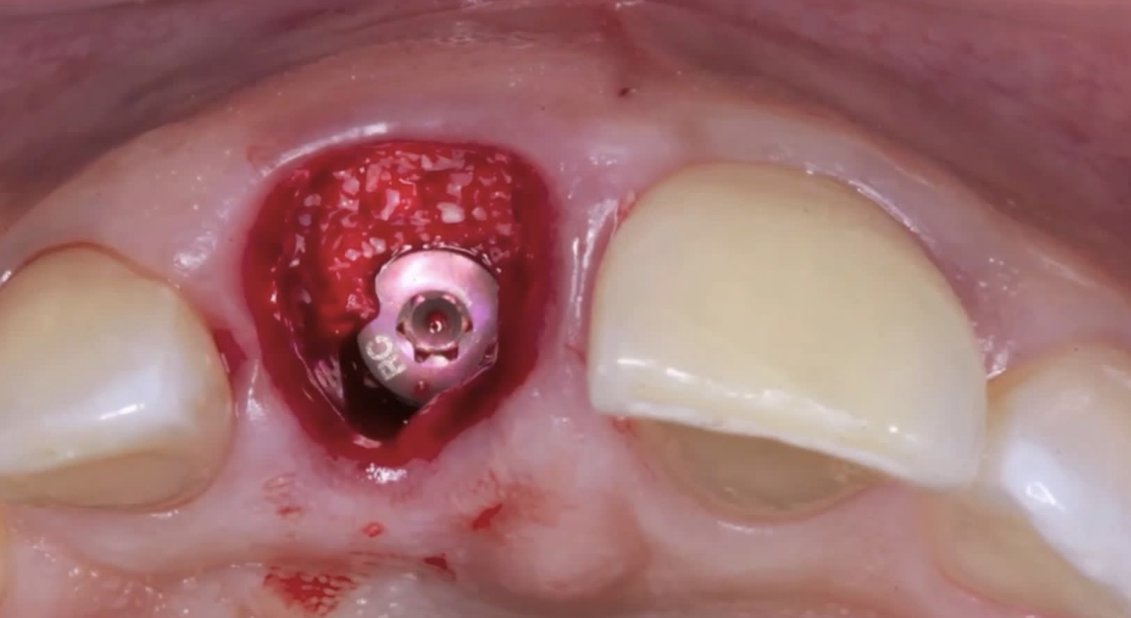 CLINICAL VIDEO Immediate Implant Placement in the Esthetic Zone