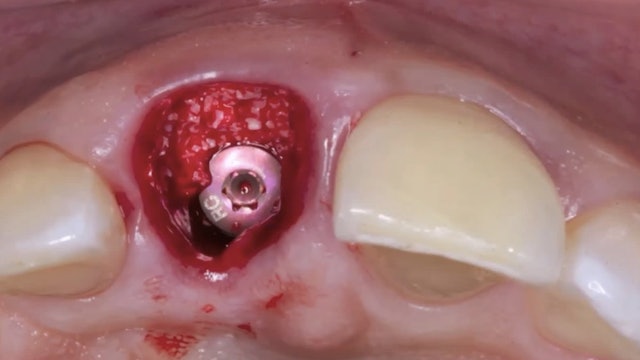 CLINICAL VIDEO Immediate Implant Placement in the Esthetic Zone