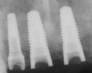 Advanced Implant Therapy - Vol. 2, 2nd edition: RIDGE AUGMENTATION (JAPANESE LA