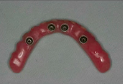 Four Implants Per Jaw - What We Have Learned in 10 Years