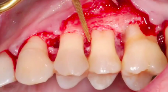 CLINICAL VIDEO Resective Periodontal Surgery Using Piezosurgery Protocol