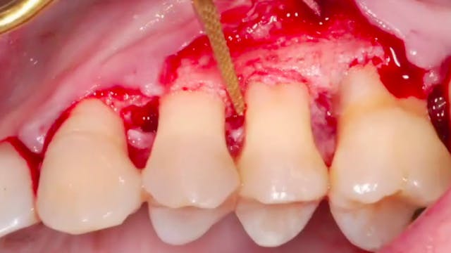 CLINICAL VIDEO Resective Periodontal ...
