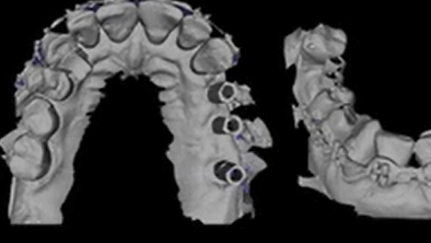 Advantages of the New Technologies in Prosthetic Dentistry | Dr  Mintrone