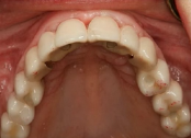 Patient Options for the Edentulous Maxilla