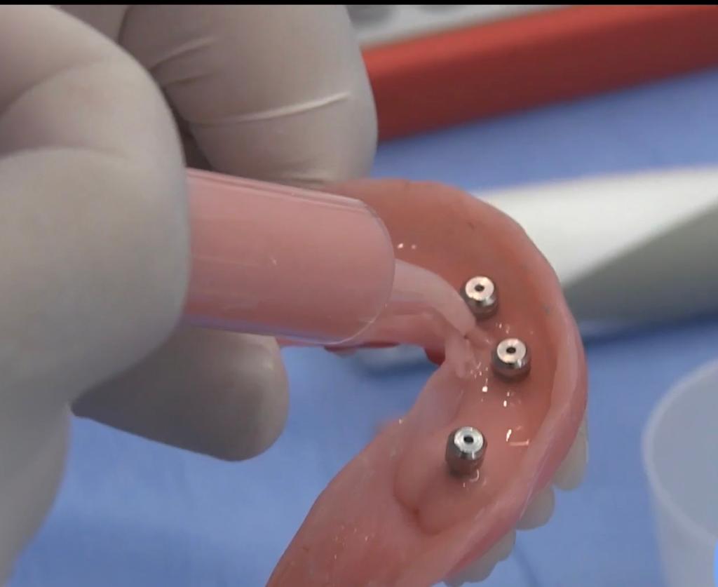 CLINICAL VIDEO Full arch All-on-4 restorative steps for Immediate loading with c