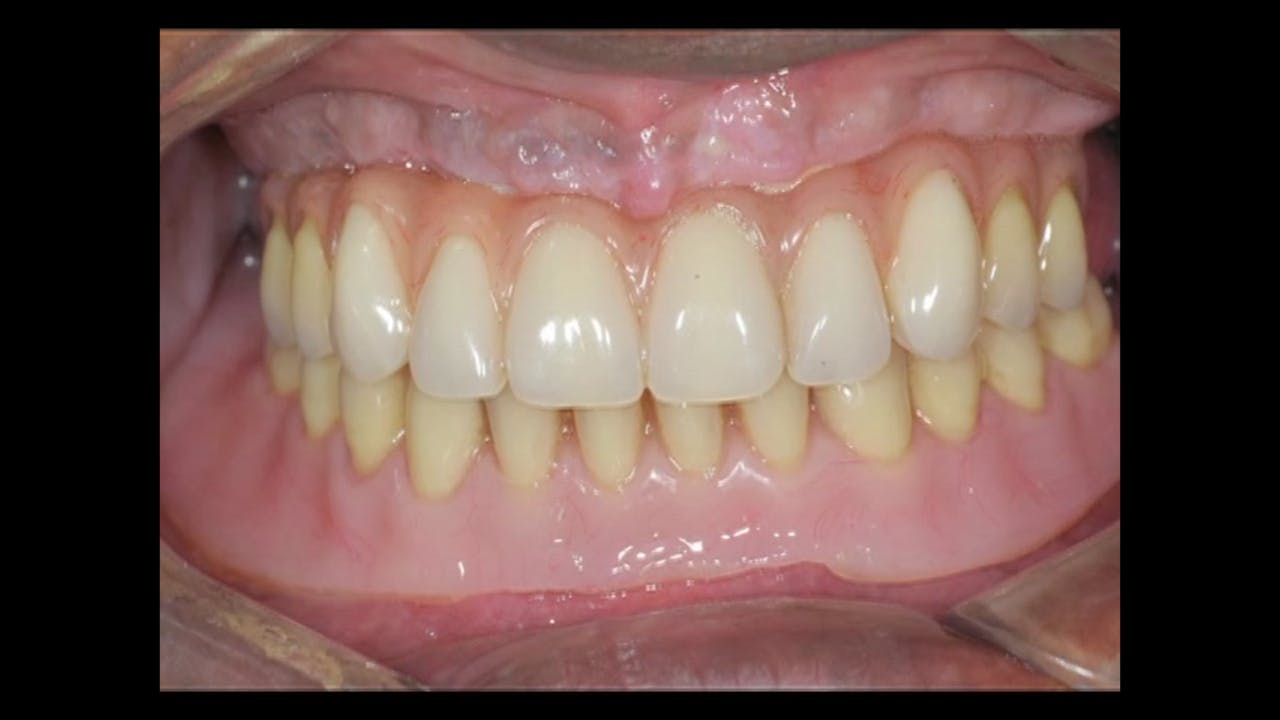 CLINICAL VIDEO Treatment of the edentulous upper jaw with CTbased