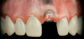 Paradigm Shift: Soft Tissue Concept | Dr Iñaki Gamborena