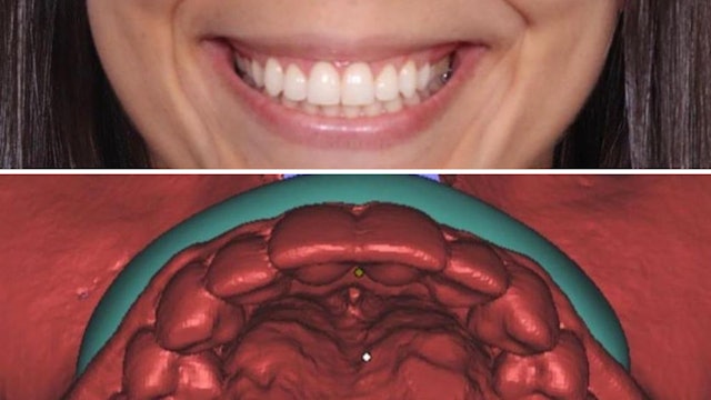 CLINICAL VIDEO Correction of a Gummy Smile With a Combination of Crown