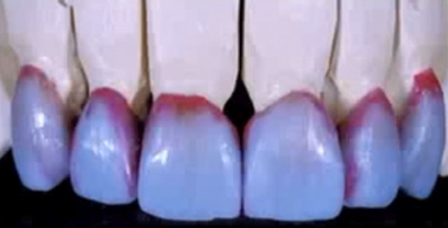 Aesthetic Challenges with All-Ceramic Restorations (ITALIAN LANGUAGE ONLY)