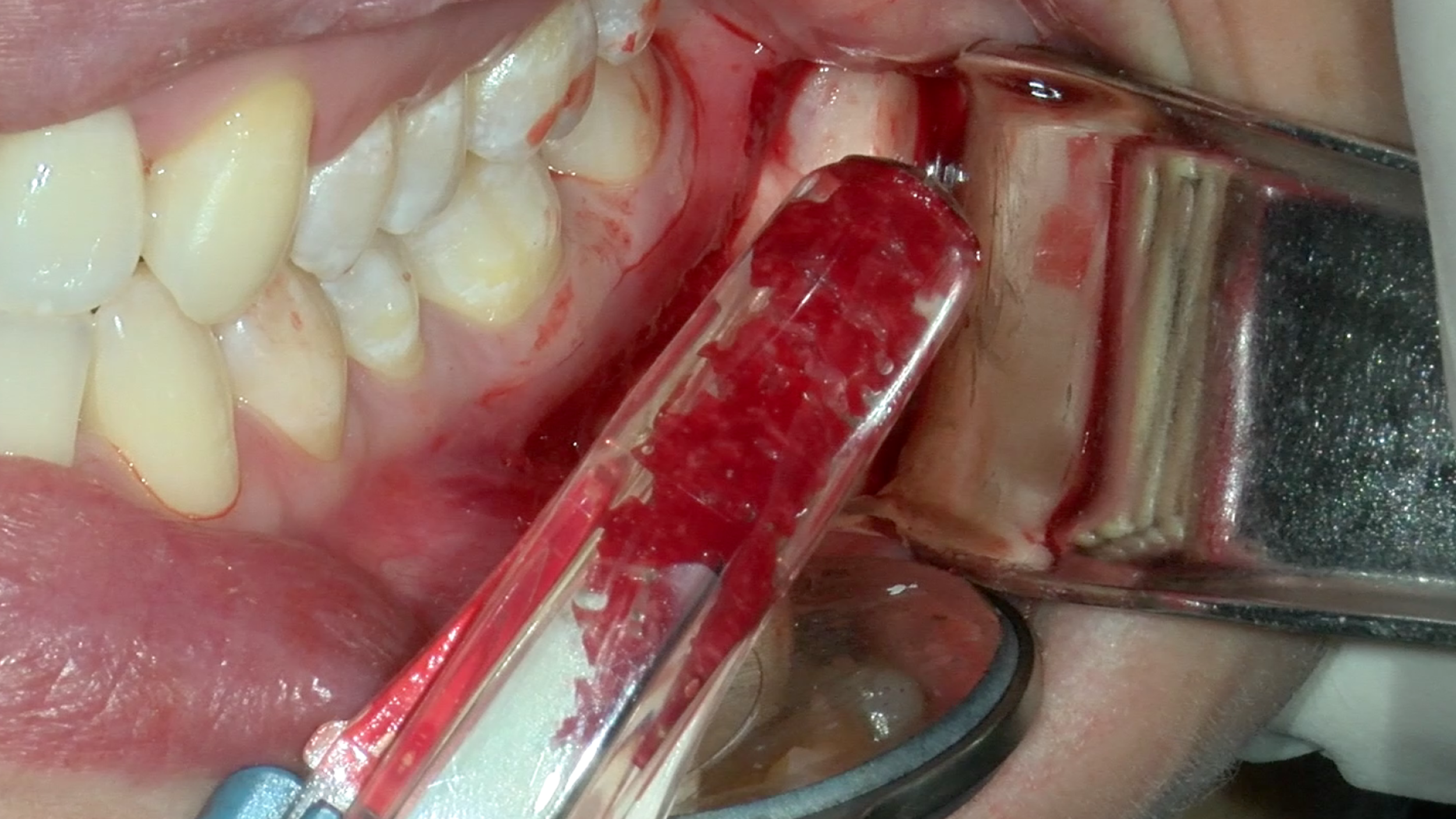 CLINICAL VIDEO Autogenous Ramus Bone Harvest Using a Bone Scraper